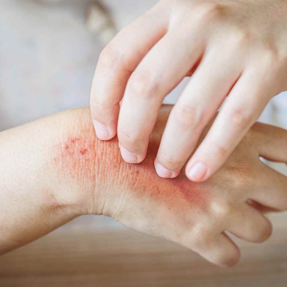 Hautausschlag: gerötete, juckende Haut am Unterarm; Dermatitis/Ekzem mit Rötung, Quaddeln und Hautirritationen als Kategoriebild